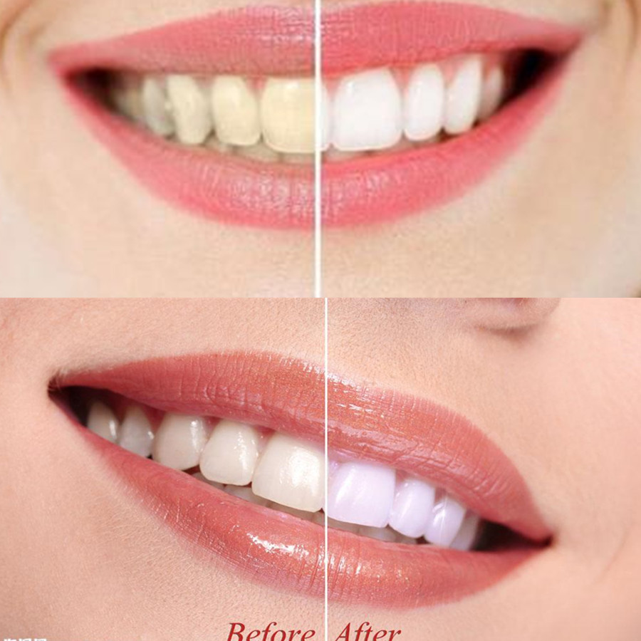 الخيزران الفحم الأسنان الأسنان - مراجعة Teeth Whitening Kit وسعره