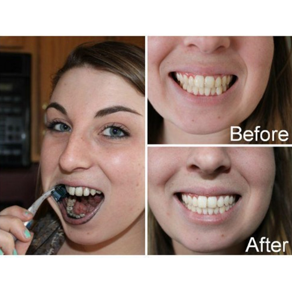 الخيزران الفحم الأسنان الأسنان - مراجعة Teeth Whitening Kit وسعره