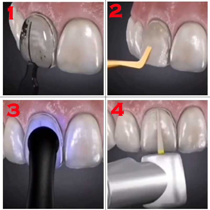 32 قطعة من أدوات تبييض الأسنان - مراجعة Teeth Whitening Moulds وسعره